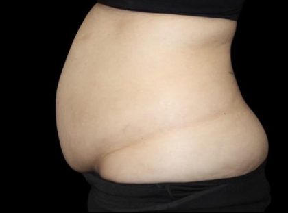 Tummy Tuck Before & After Patient #476
