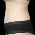 Tummy Tuck Before & After Patient #476