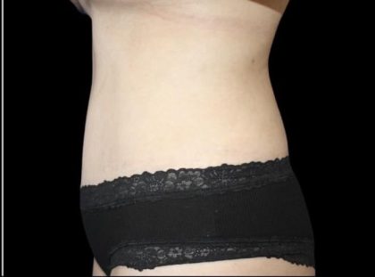 Tummy Tuck Before & After Patient #476