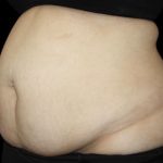 Tummy Tuck Before & After Patient #476