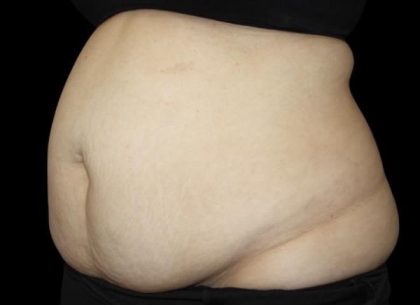 Tummy Tuck Before & After Patient #476