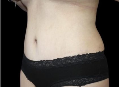 Tummy Tuck Before & After Patient #476