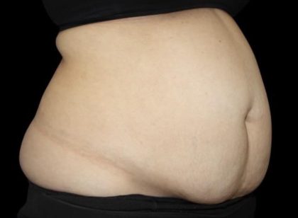 Tummy Tuck Before & After Patient #476