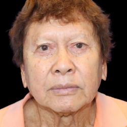 Facelift Before & After Patient #477