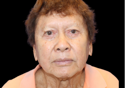 Facelift Before & After Patient #477