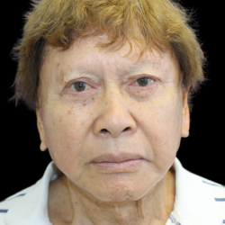 Facelift Before & After Patient #477
