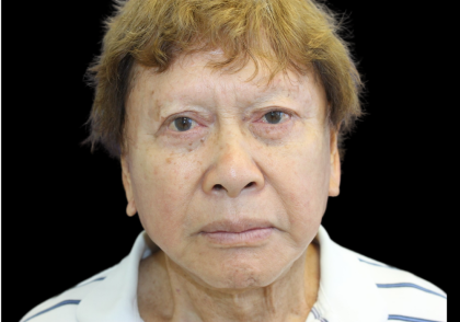 Facelift Before & After Patient #477