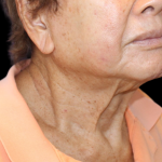 Facelift Before & After Patient #477