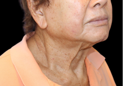 Facelift Before & After Patient #477