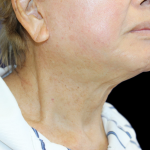Facelift Before & After Patient #477
