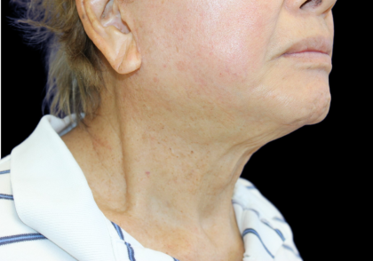 Facelift Before & After Patient #477