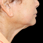 Facelift Before & After Patient #477
