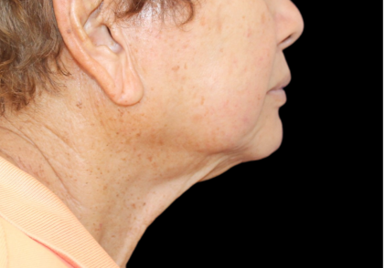 Facelift Before & After Patient #477