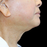 Facelift Before & After Patient #477