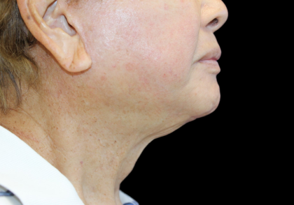 Facelift Before & After Patient #477