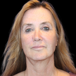Facelift Before & After Patient #478