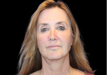 Facelift Before & After Patient #478
