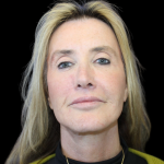 Facelift Before & After Patient #478