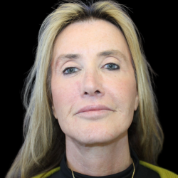 Facelift Before & After Patient #478