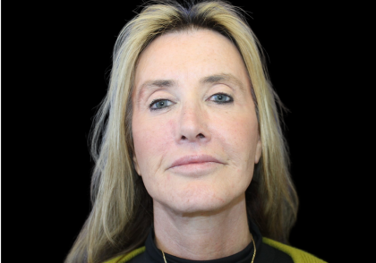 Facelift Before & After Patient #478