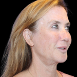 Facelift Before & After Patient #478