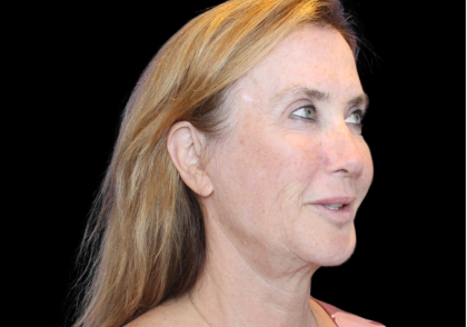 Facelift Before & After Patient #478