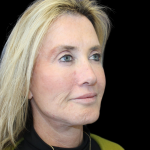 Facelift Before & After Patient #478