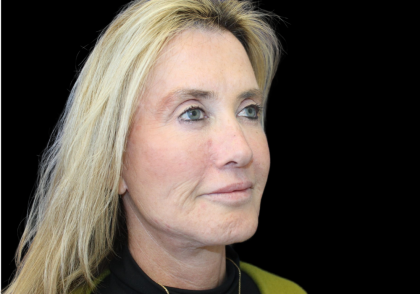 Facelift Before & After Patient #478