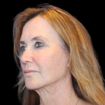 Facelift Before & After Patient #478