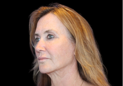 Facelift Before & After Patient #478