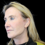 Facelift Before & After Patient #478