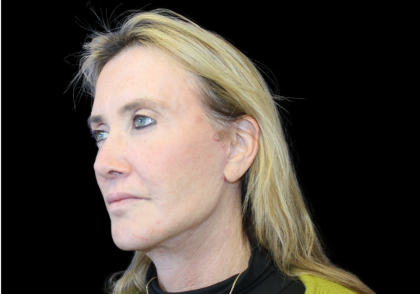 Facelift Before & After Patient #478