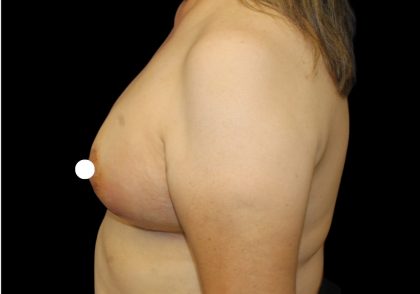 Breast Lift Before & After Patient #481