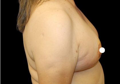 Breast Lift Before & After Patient #481