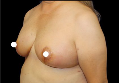 Breast Lift Before & After Patient #481