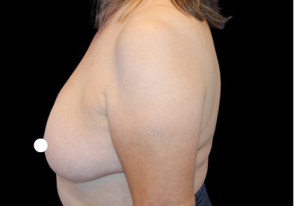 Breast Lift Before & After Patient #481