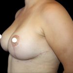 Breast Lift Before & After Patient #482
