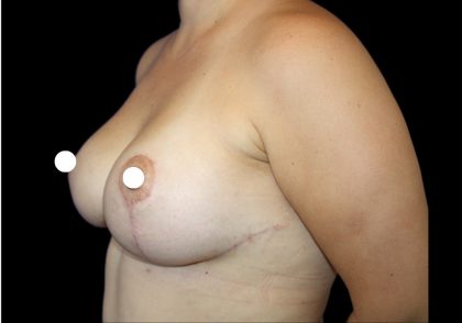 Breast Lift Before & After Patient #482