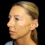 Facelift Before & After Patient #479