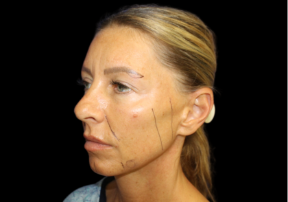 Facelift Before & After Patient #479