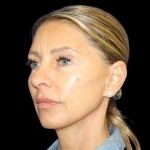 Facelift Before & After Patient #479