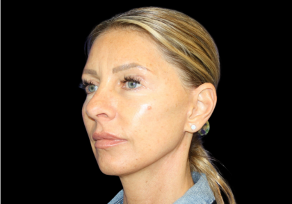 Facelift Before & After Patient #479