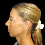 Facelift Before & After Patient #479