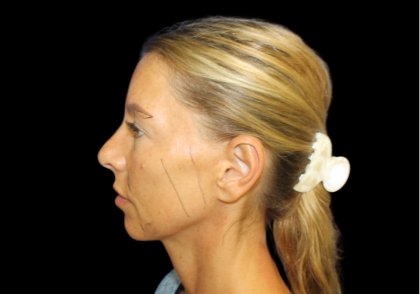 Facelift Before & After Patient #479