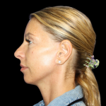Facelift Before & After Patient #479