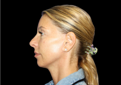 Facelift Before & After Patient #479