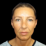 Facelift Before & After Patient #479