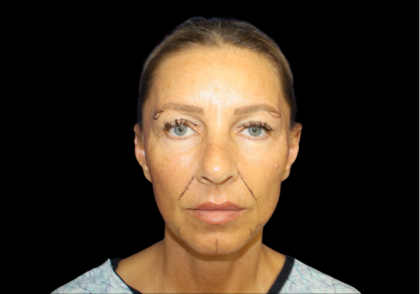 Facelift Before & After Patient #479