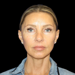 Facelift Before & After Patient #479