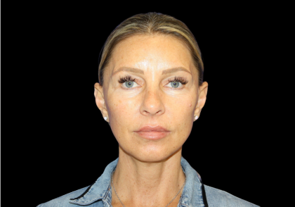 Facelift Before & After Patient #479